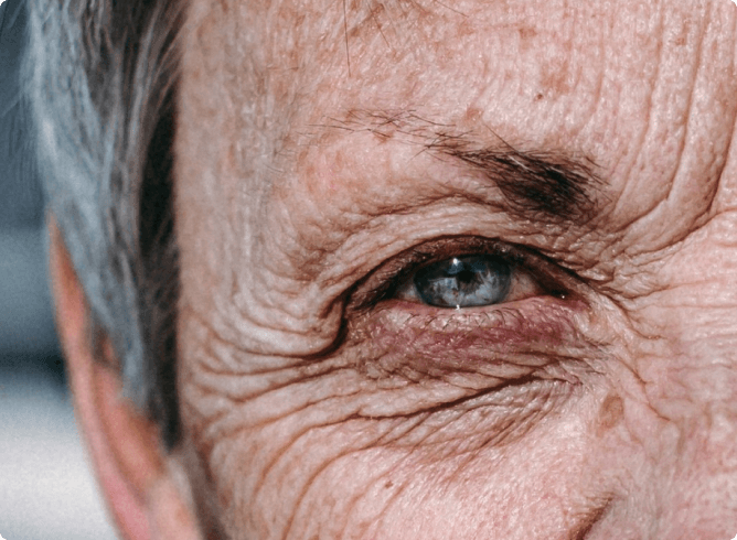 Age Related Macular Degeneration